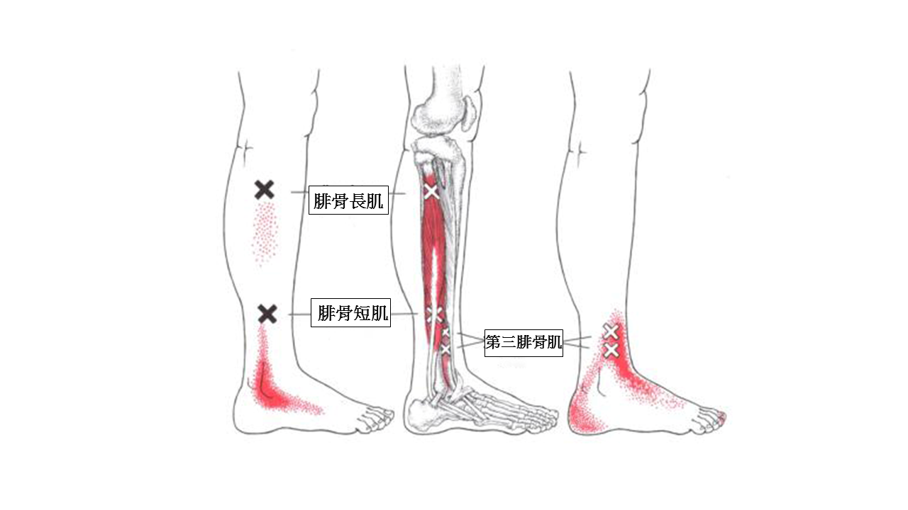 扭傷後遺症一直好不了 快來按摩你的腓骨長短肌 Vol Sports